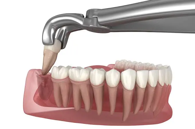 Wisdom Tooth Extraction